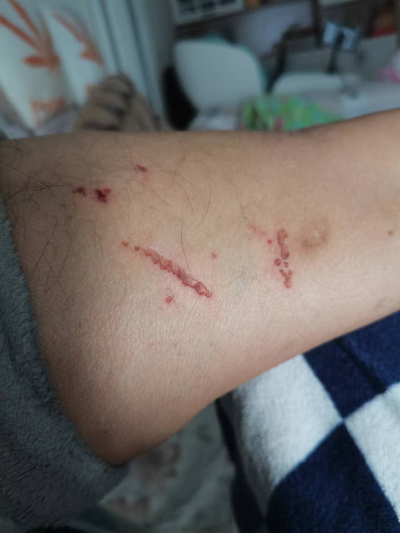 同事,聚餐,喝大,了,路上,实打实,摔,一下,前天, . 同事聚餐喝大了,路上实打实摔了一下